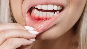 Ilustração de bolinha na gengiva, sintoma que pode indicar abscesso ou fibroma