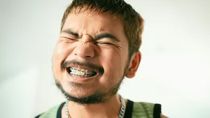 Aparelho ortodôntico fixo metálico em dentes, ilustrando o tratamento em pacientes com bruxismo
