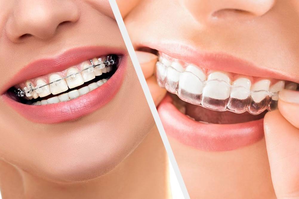 Alinhador invisível ou aparelho fixo – qual a melhor escolha?