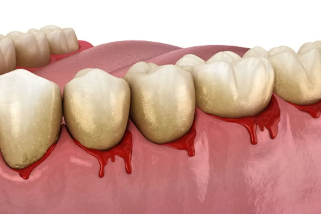 Imagem ilustrativa de gengiva sangrando, destacando a inflamação e acúmulo de tártaro. Representação visual dos sinais da gengivite e periodontite.