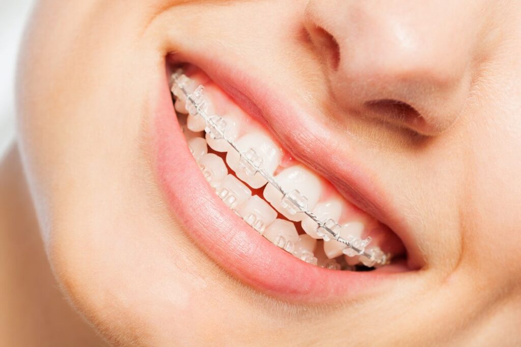 Alinhadores invisíveis sendo colocados em dentes perfeitamente alinhados