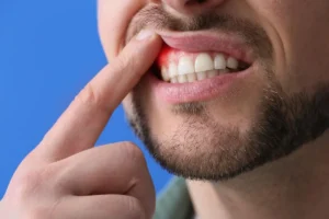 gengivite x periodontite tratamento