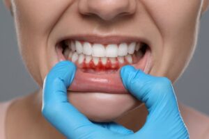 Periodontia: O Guia Completo para Prevenir e Tratar Doenças Periodontais