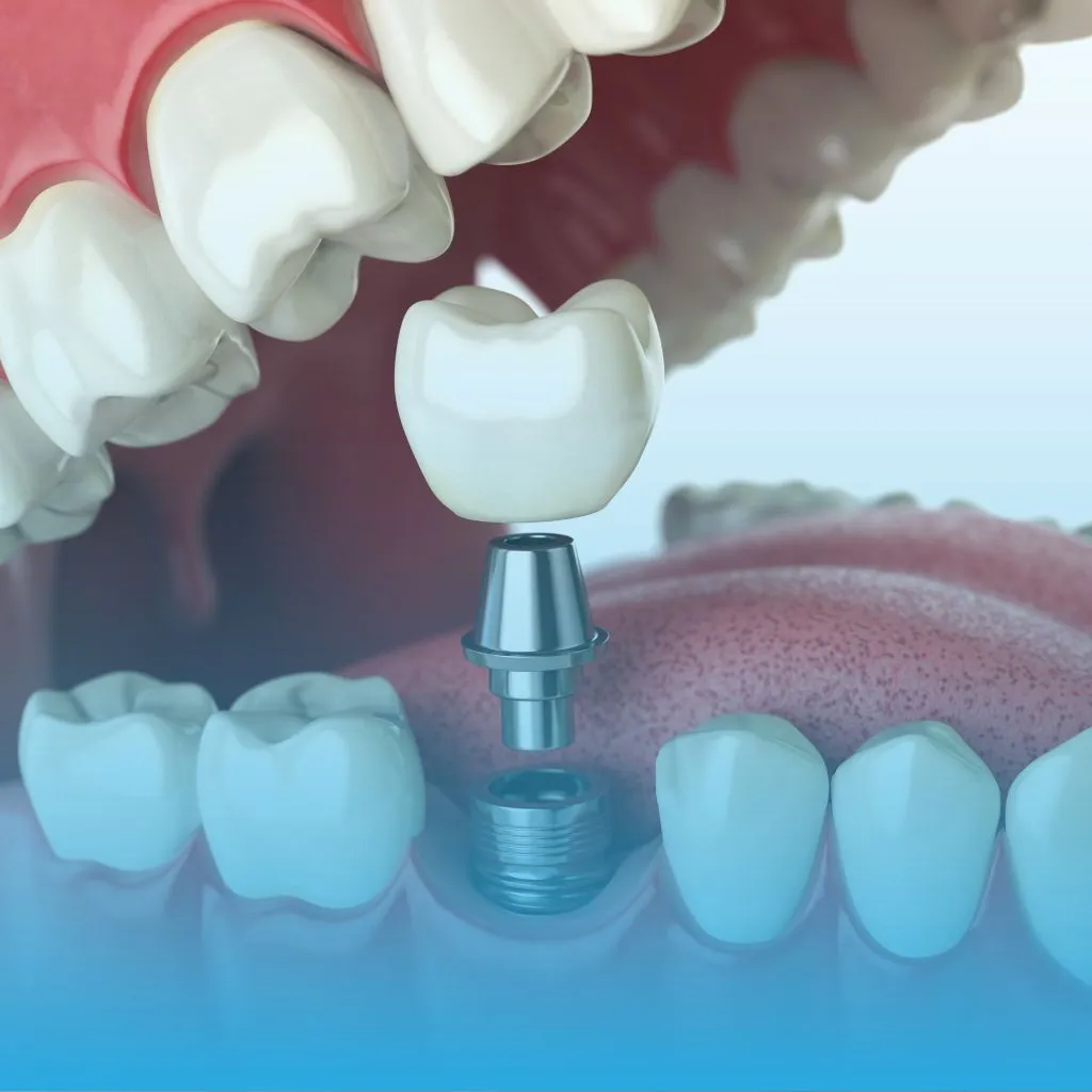 Dentista na Taquara - Implante Dentário para reabilitação oral na Stelle Odontologia.
