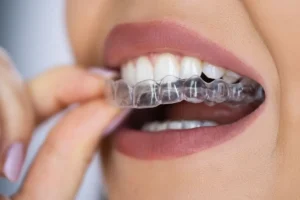 Alinhadores Invisíveis: O Guia Completo para um Sorriso Perfeito em 2025