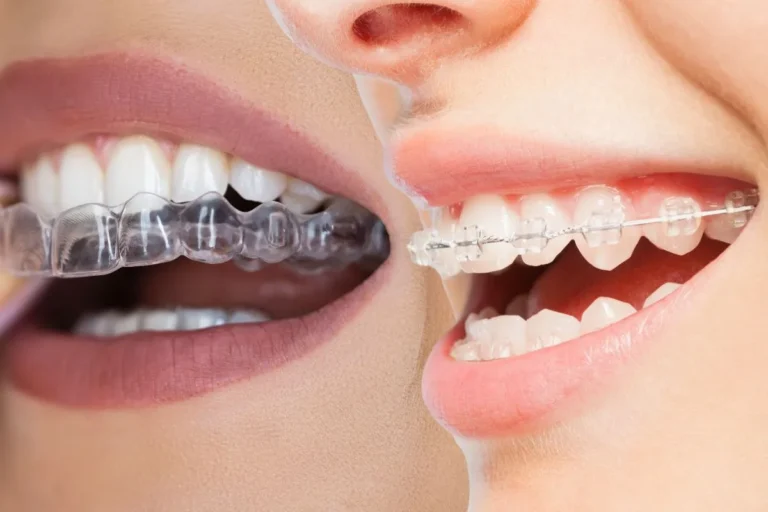Alinhadores Invisíveis x Aparelhos Ortodônticos Transparentes: Qual a Melhor Escolha?
